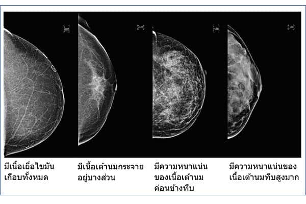 มะเร็งเต้านม