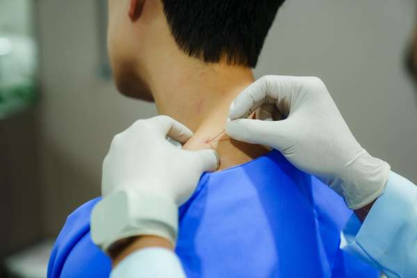 Dry Needling